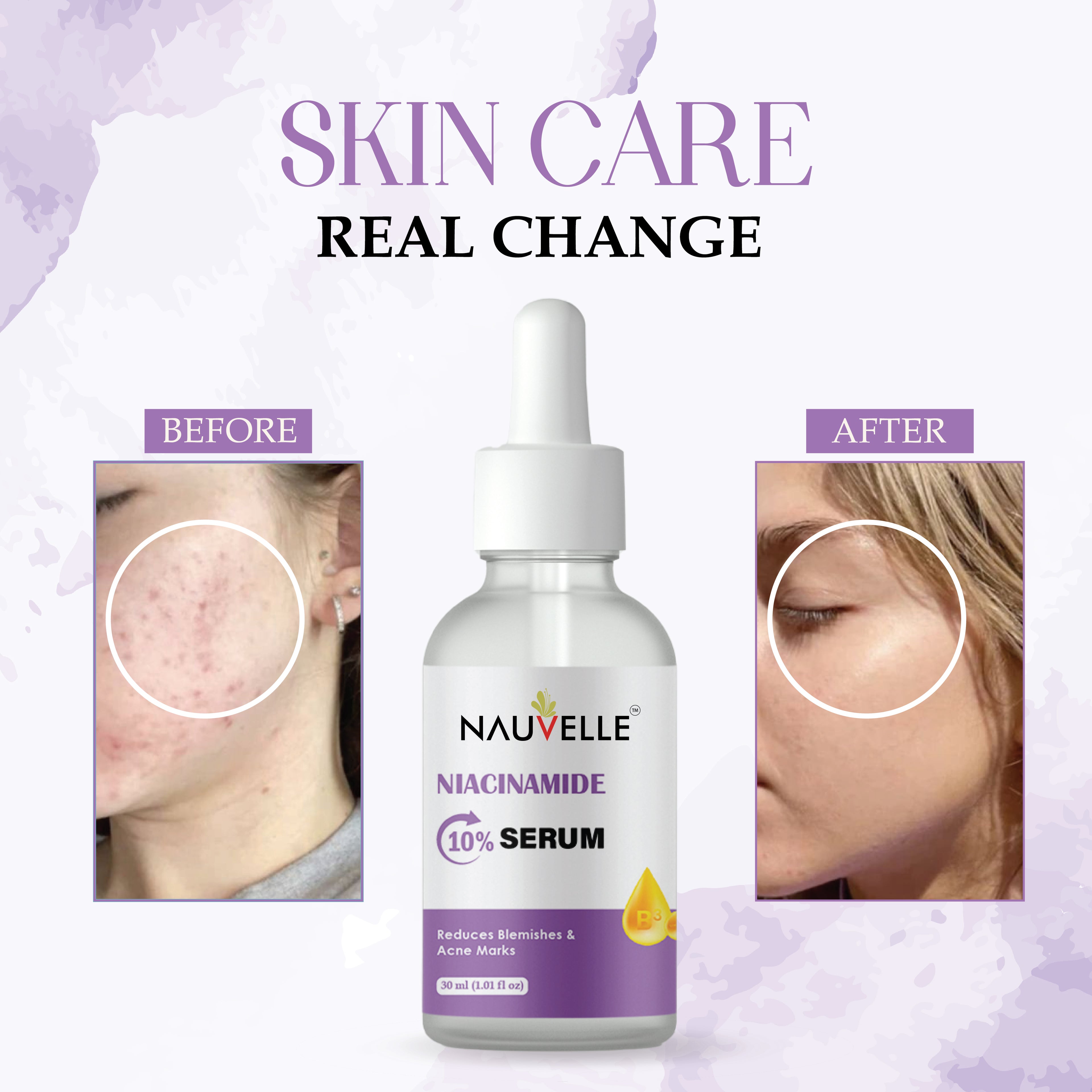 Nauvelle Niacinamide 10% Serum, Reduces Blemishes & Acne Marks, 30ml